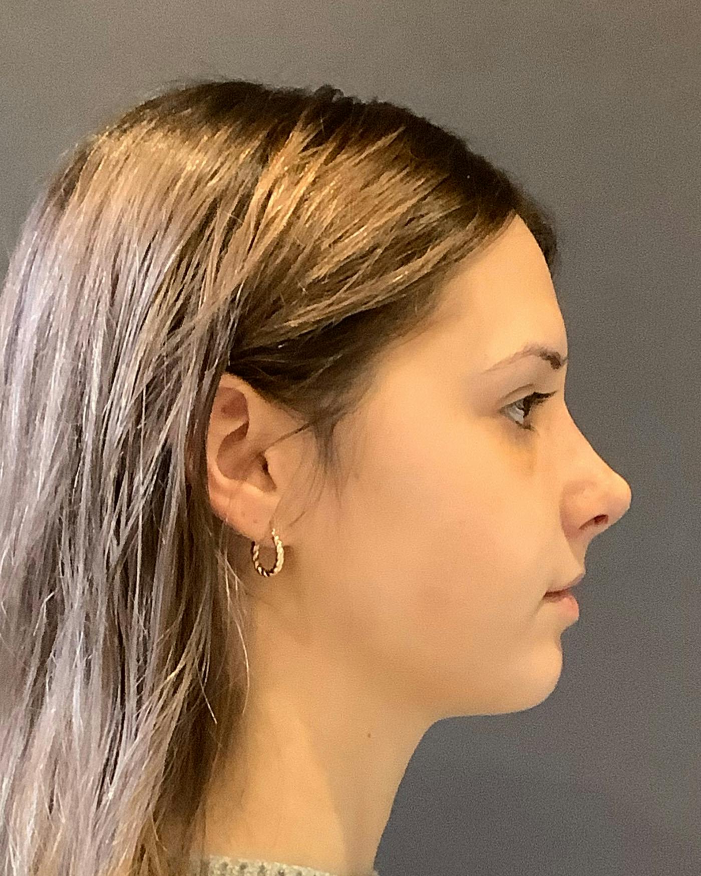 Rhinoplasty Before & After Gallery - Patient 191294098 - Image 2