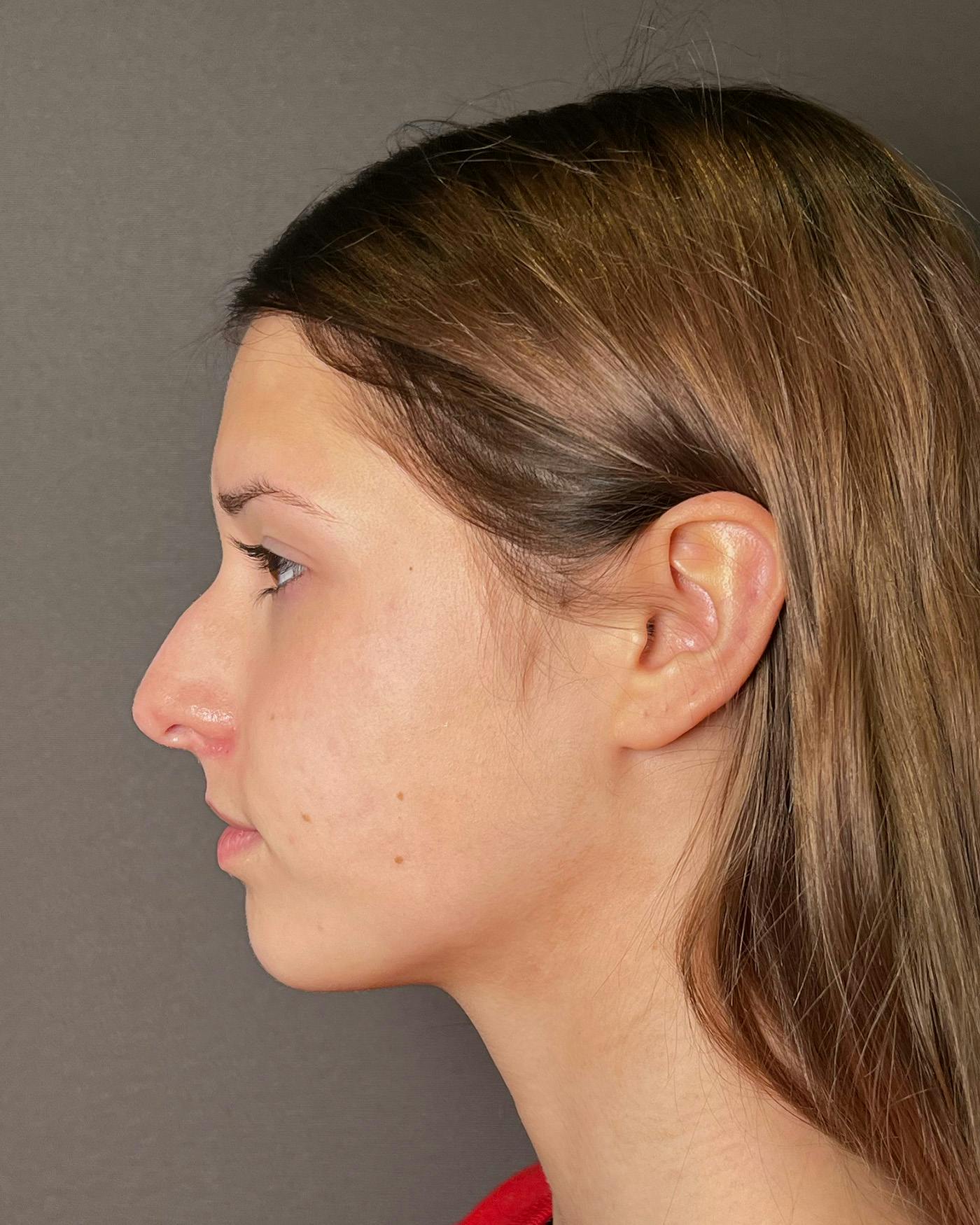 Rhinoplasty Before & After Gallery - Patient 191294098 - Image 5