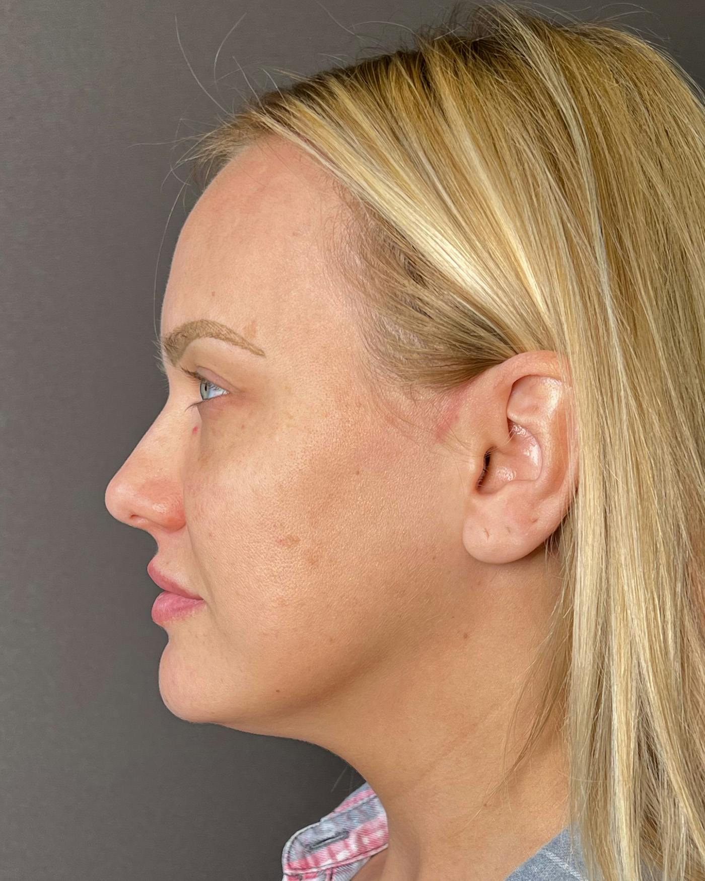 Rhinoplasty Before & After Gallery - Patient 191294109 - Image 7