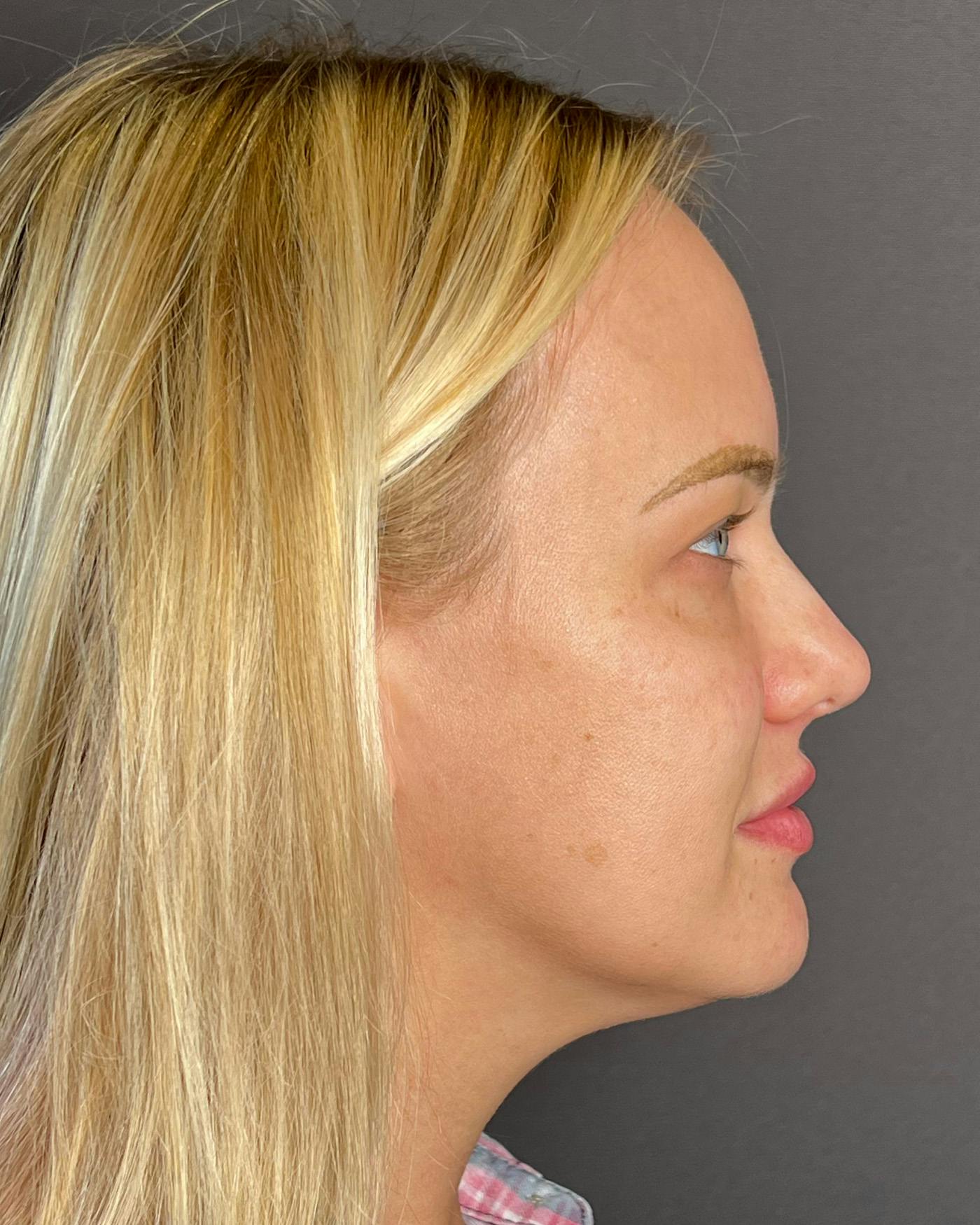 Rhinoplasty Before & After Gallery - Patient 191294109 - Image 1