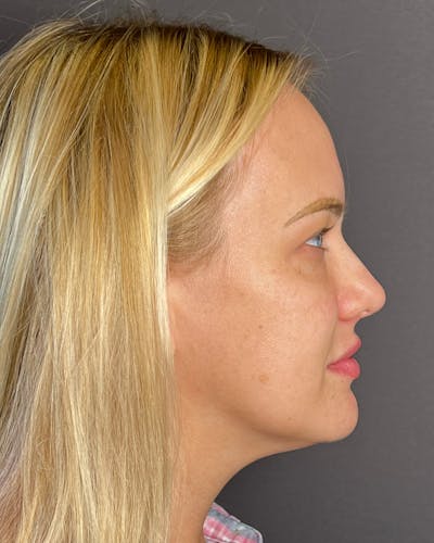 Rhinoplasty Before & After Gallery - Patient 191294109 - Image 1