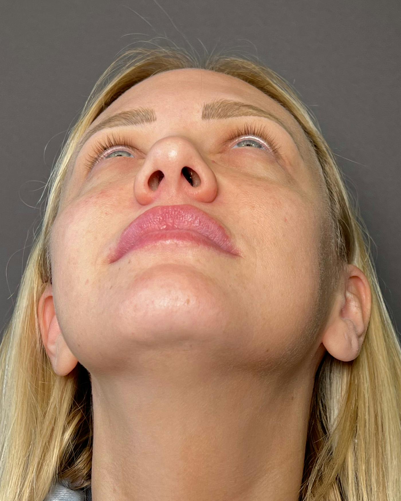 Rhinoplasty Before & After Gallery - Patient 191294109 - Image 9