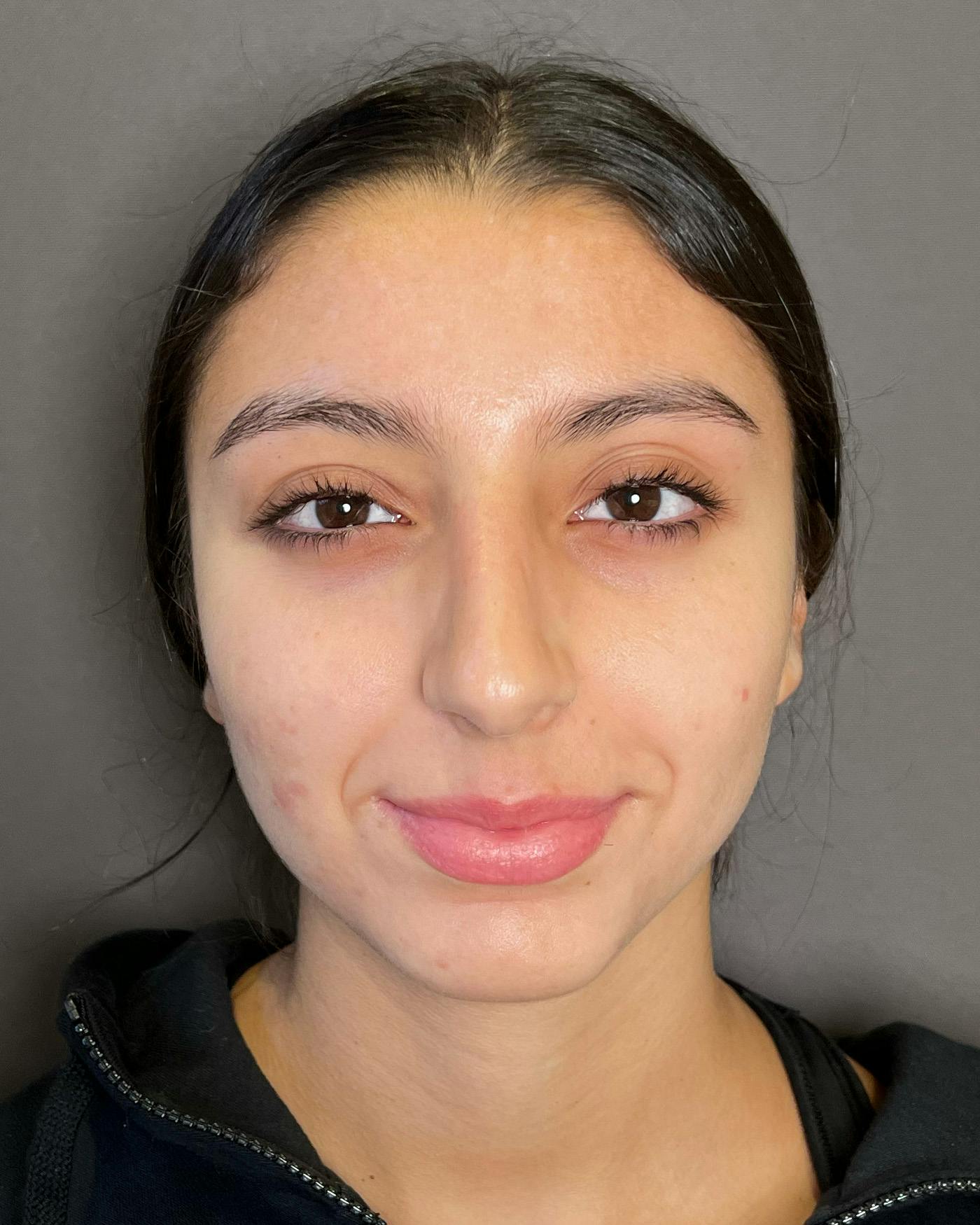 Rhinoplasty Before & After Gallery - Patient 191294113 - Image 3