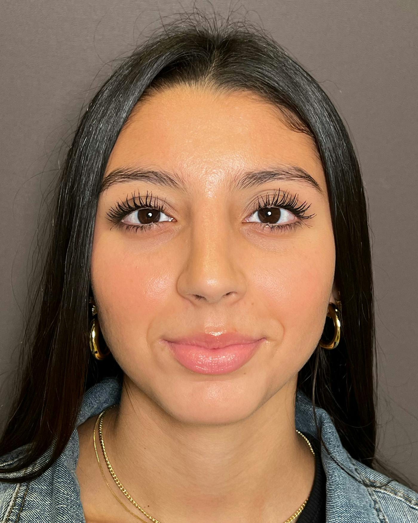 Rhinoplasty Before & After Gallery - Patient 191294113 - Image 4