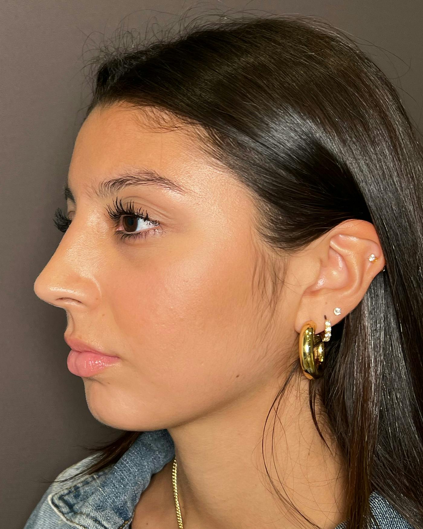 Rhinoplasty Before & After Gallery - Patient 191294113 - Image 8