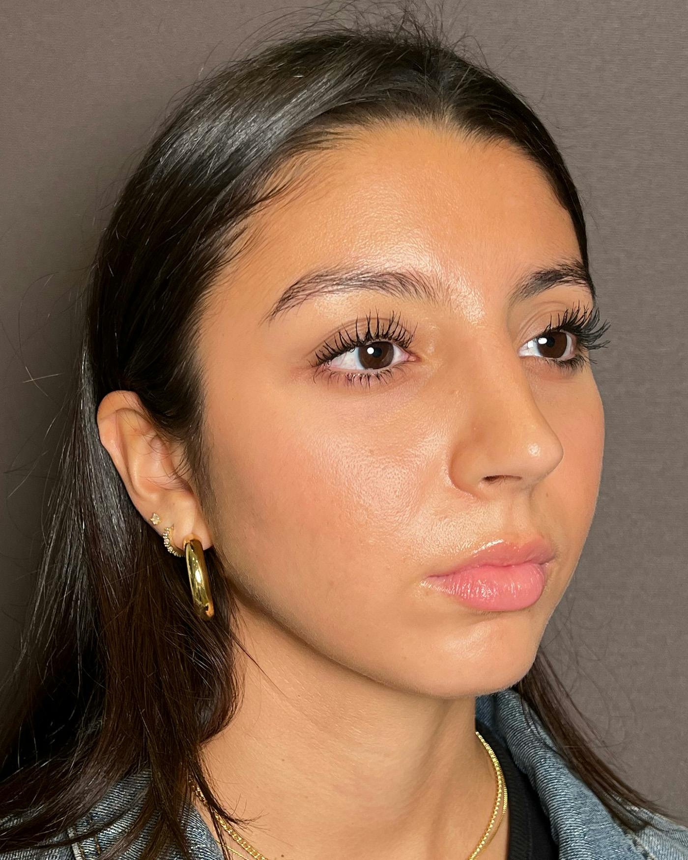 Rhinoplasty Before & After Gallery - Patient 191294113 - Image 6