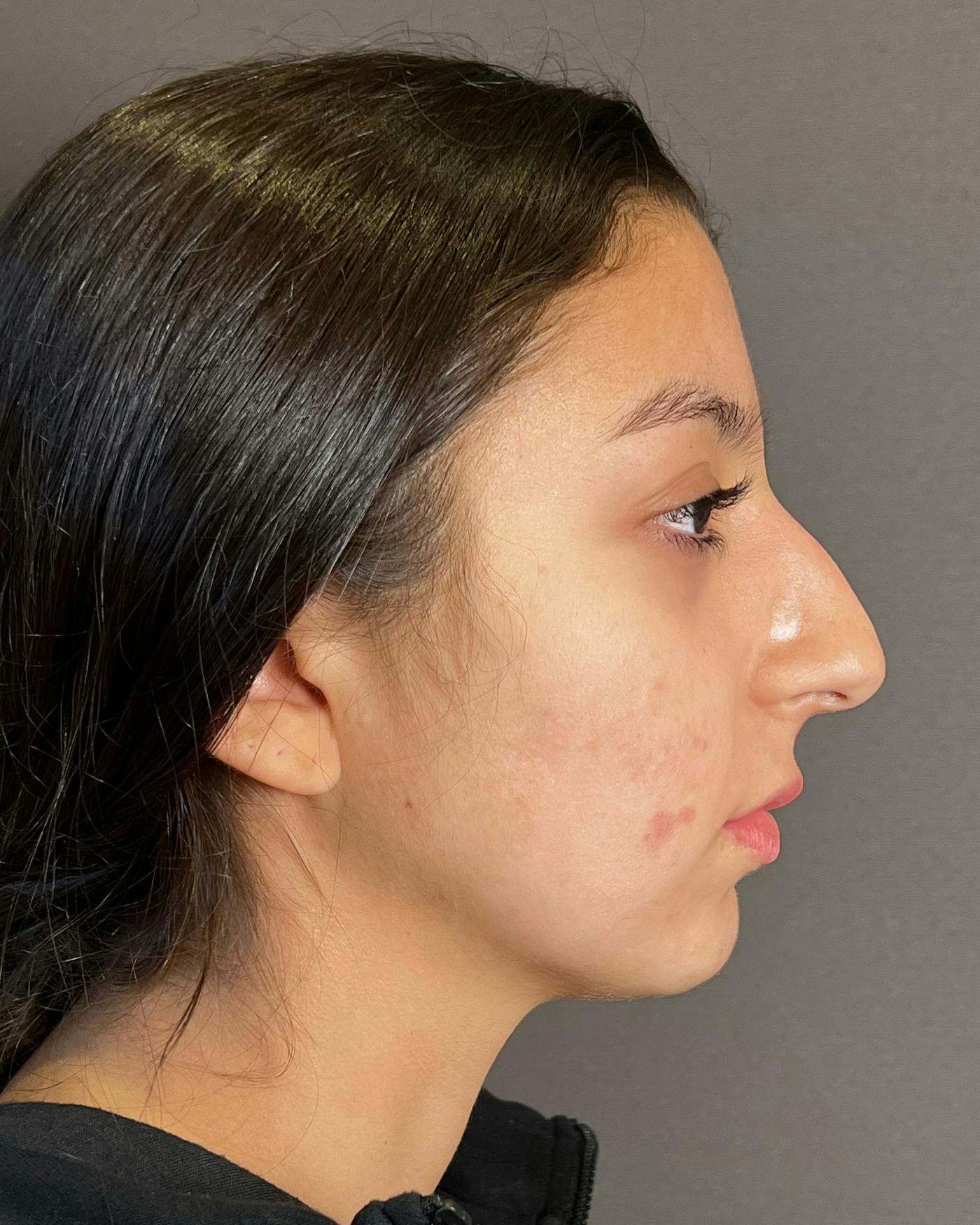 Rhinoplasty Before & After Gallery - Patient 191294113 - Image 1