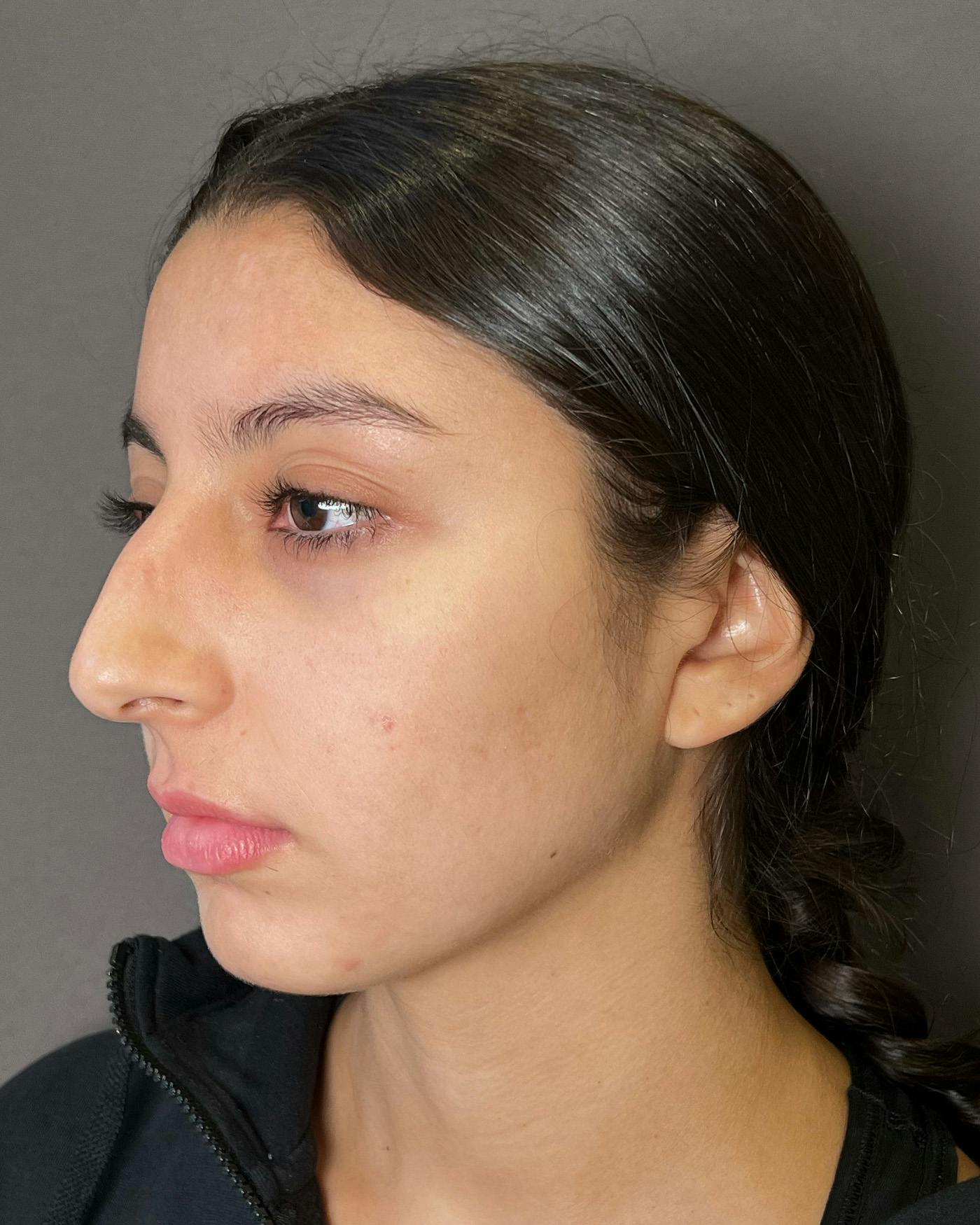 Rhinoplasty Before & After Gallery - Patient 191294113 - Image 7