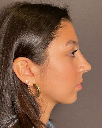 Rhinoplasty Before & After Gallery - Patient 191294113 - Image 2