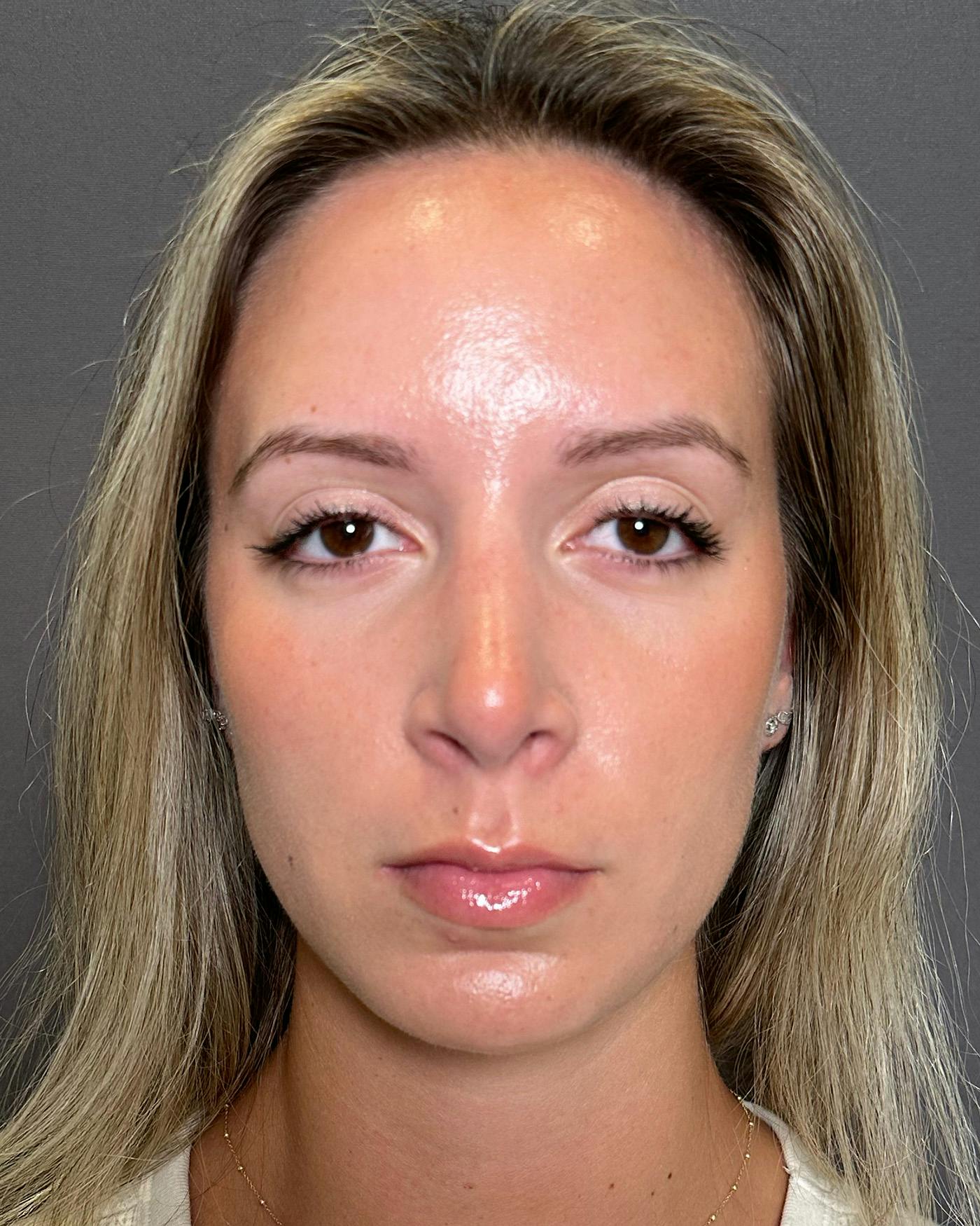 Revision Rhinoplasty Before & After Gallery - Patient 192560644 - Image 4