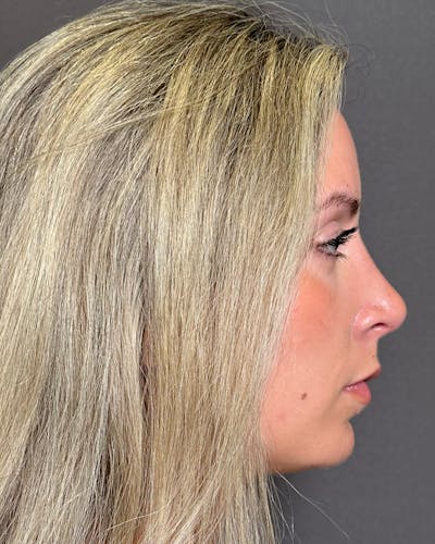 Revision Rhinoplasty Before & After Gallery - Patient 192560644 - Image 2