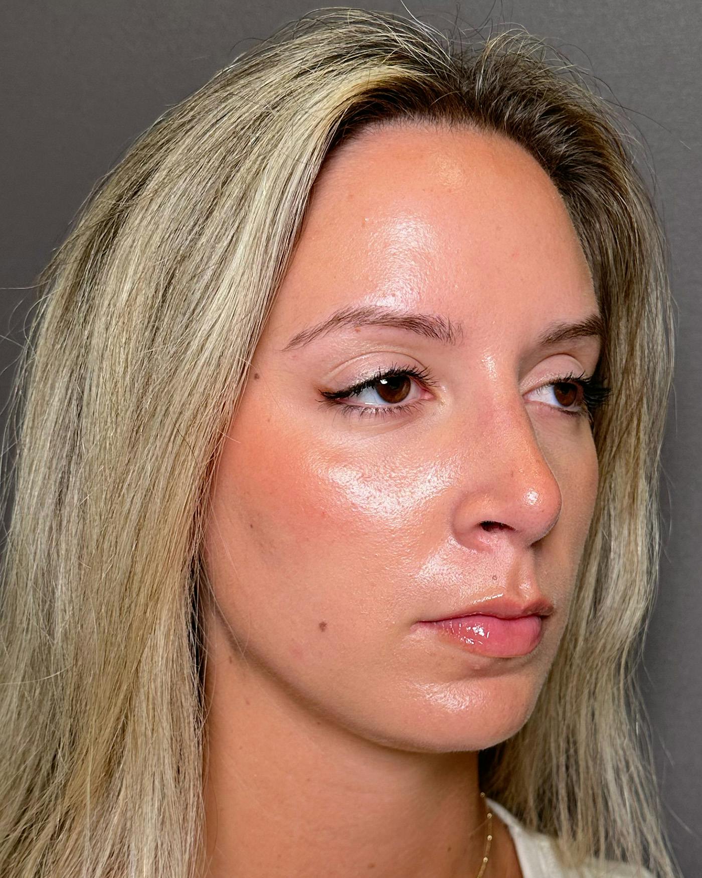 Rhinoplasty Before & After Gallery - Patient 191294117 - Image 6
