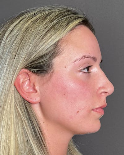 Rhinoplasty Before & After Gallery - Patient 191294117 - Image 1