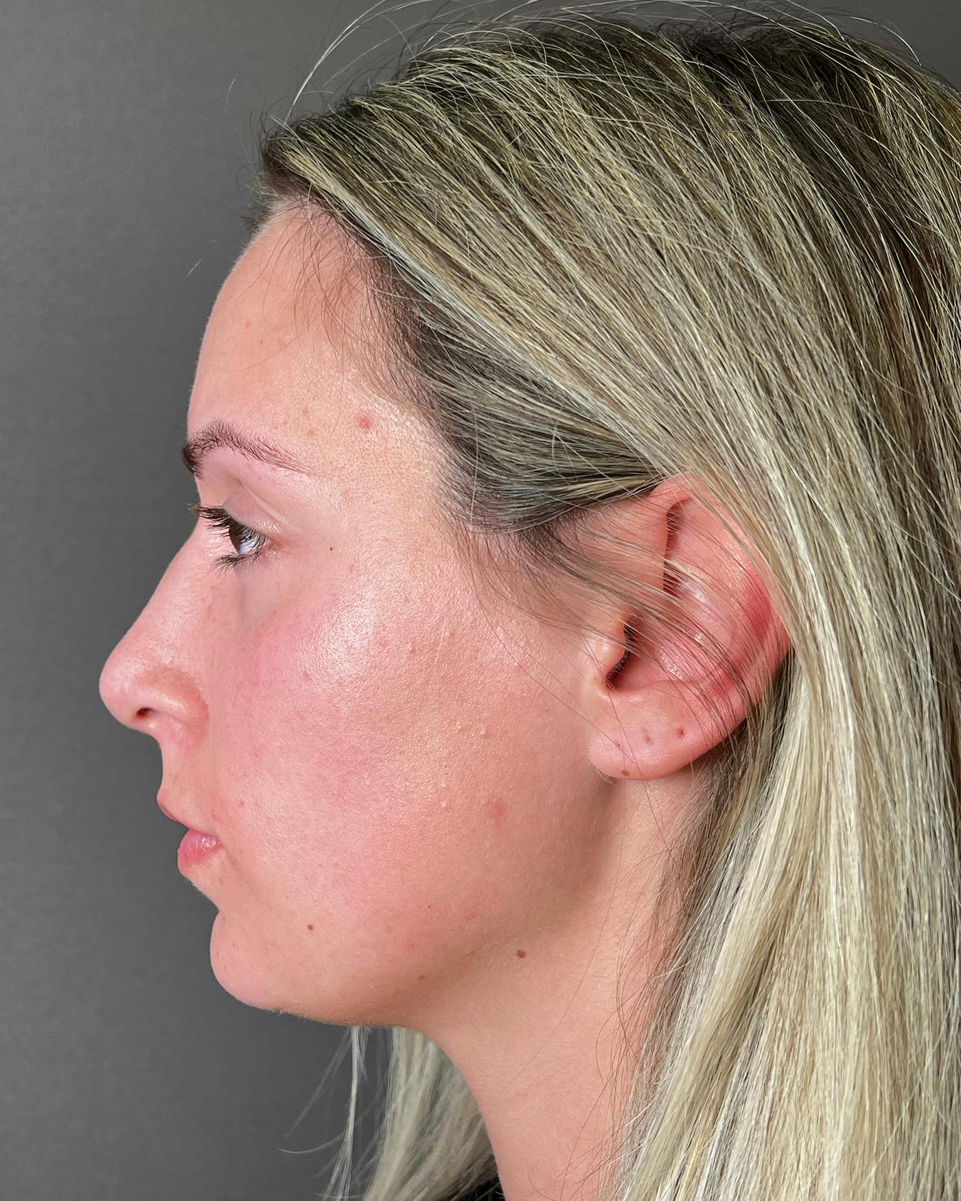 Rhinoplasty Before & After Gallery - Patient 191294117 - Image 7