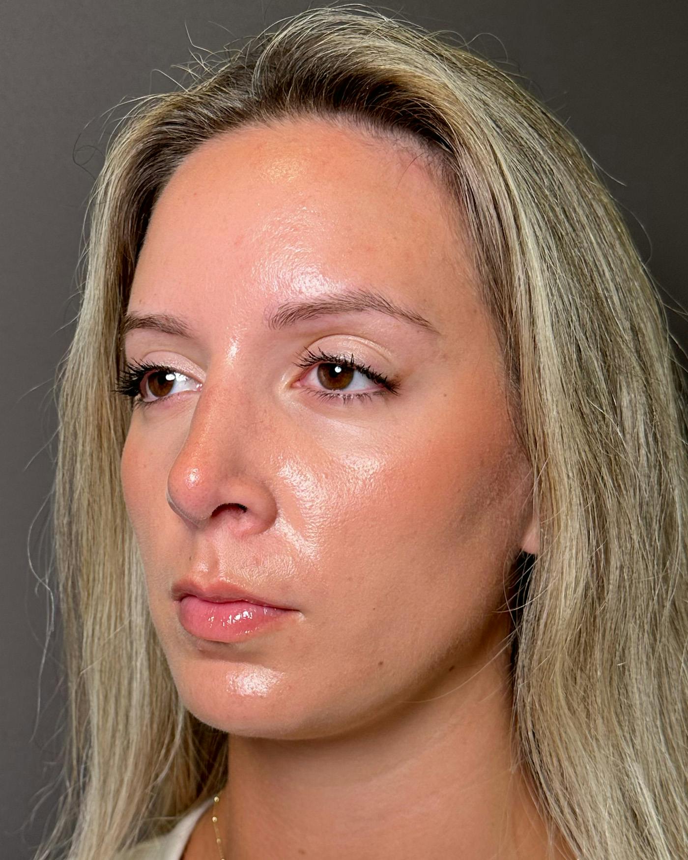 Rhinoplasty Before & After Gallery - Patient 191294117 - Image 10