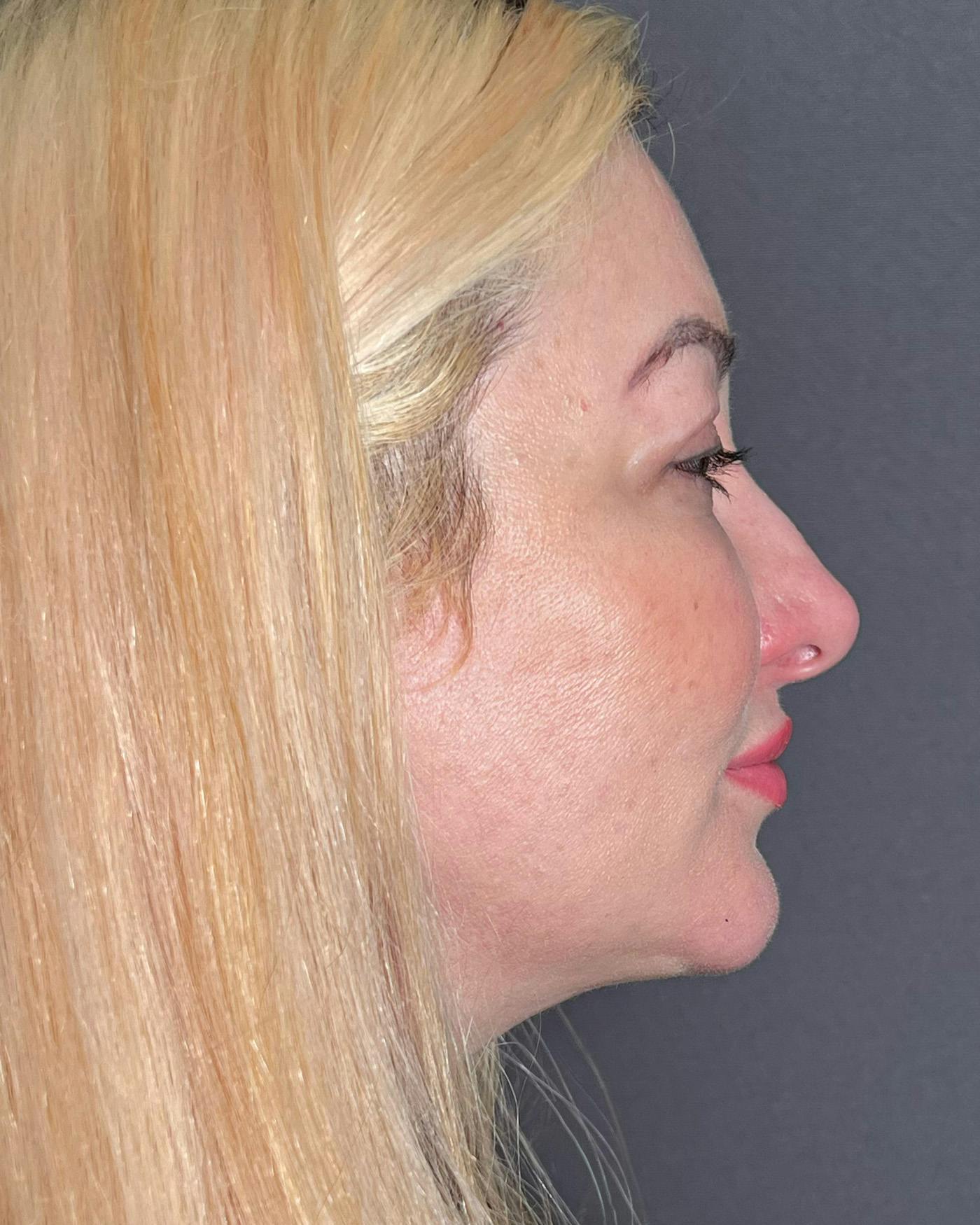 Rhinoplasty Before & After Gallery - Patient 191298455 - Image 1