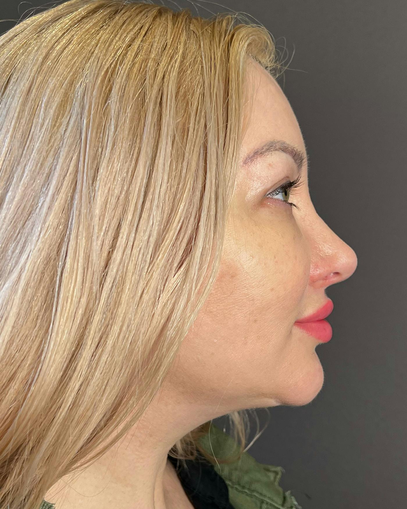 Rhinoplasty Before & After Gallery - Patient 191298455 - Image 2