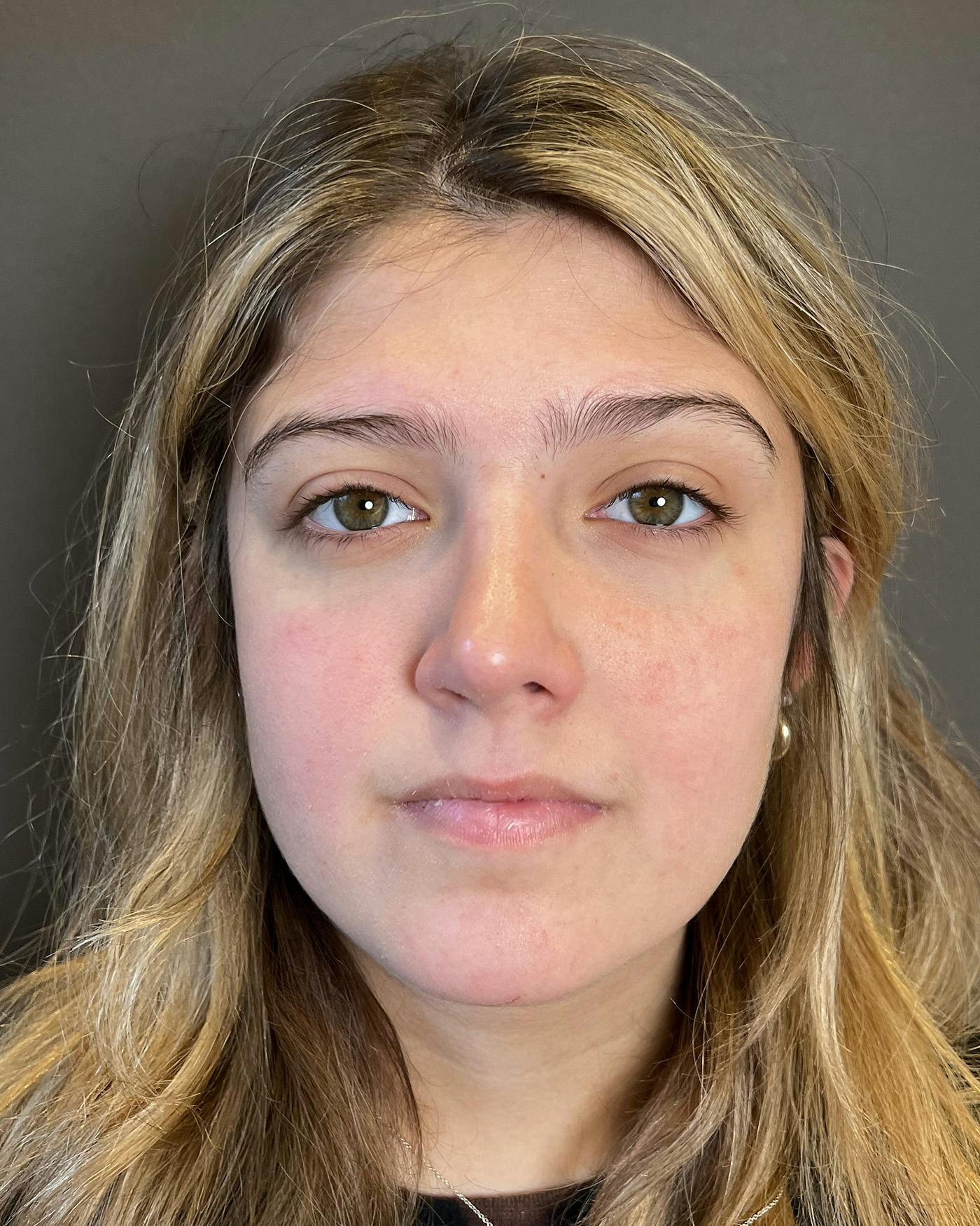 Rhinoplasty Before & After Gallery - Patient 191298487 - Image 6