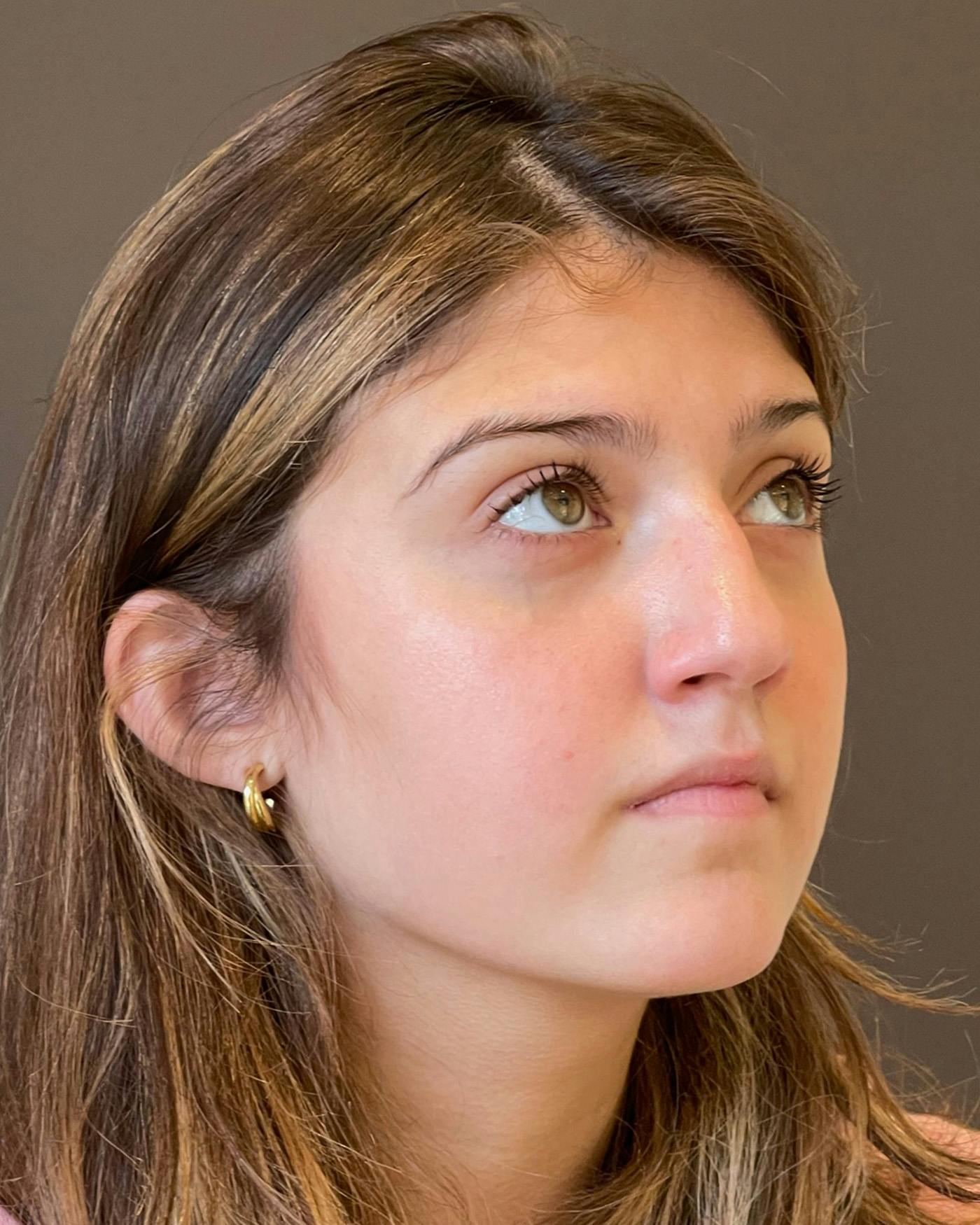 Rhinoplasty Before & After Gallery - Patient 191298487 - Image 3
