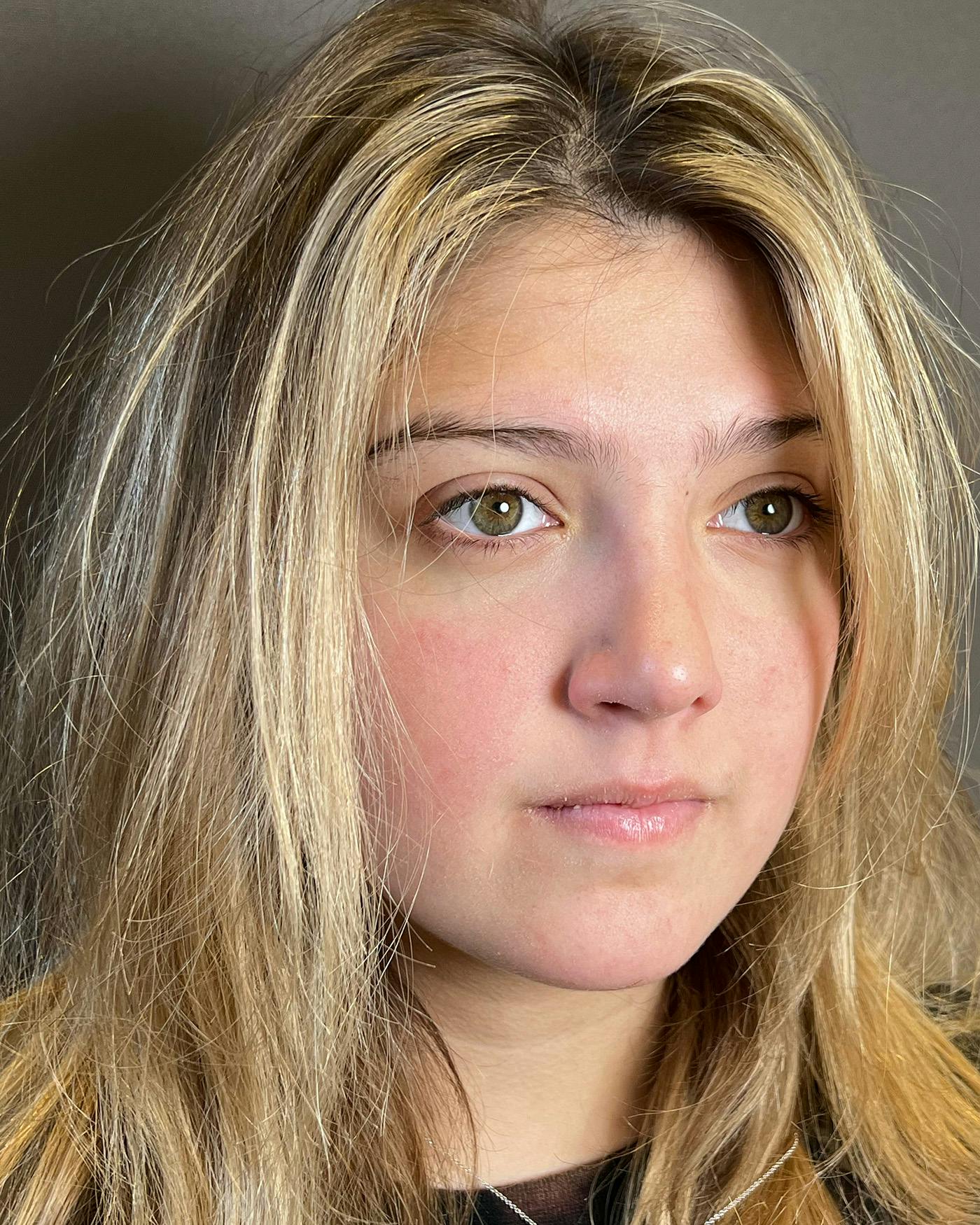 Rhinoplasty Before & After Gallery - Patient 191298487 - Image 4