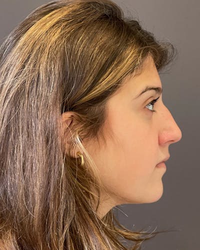 Rhinoplasty Before & After Gallery - Patient 191298487 - Image 1