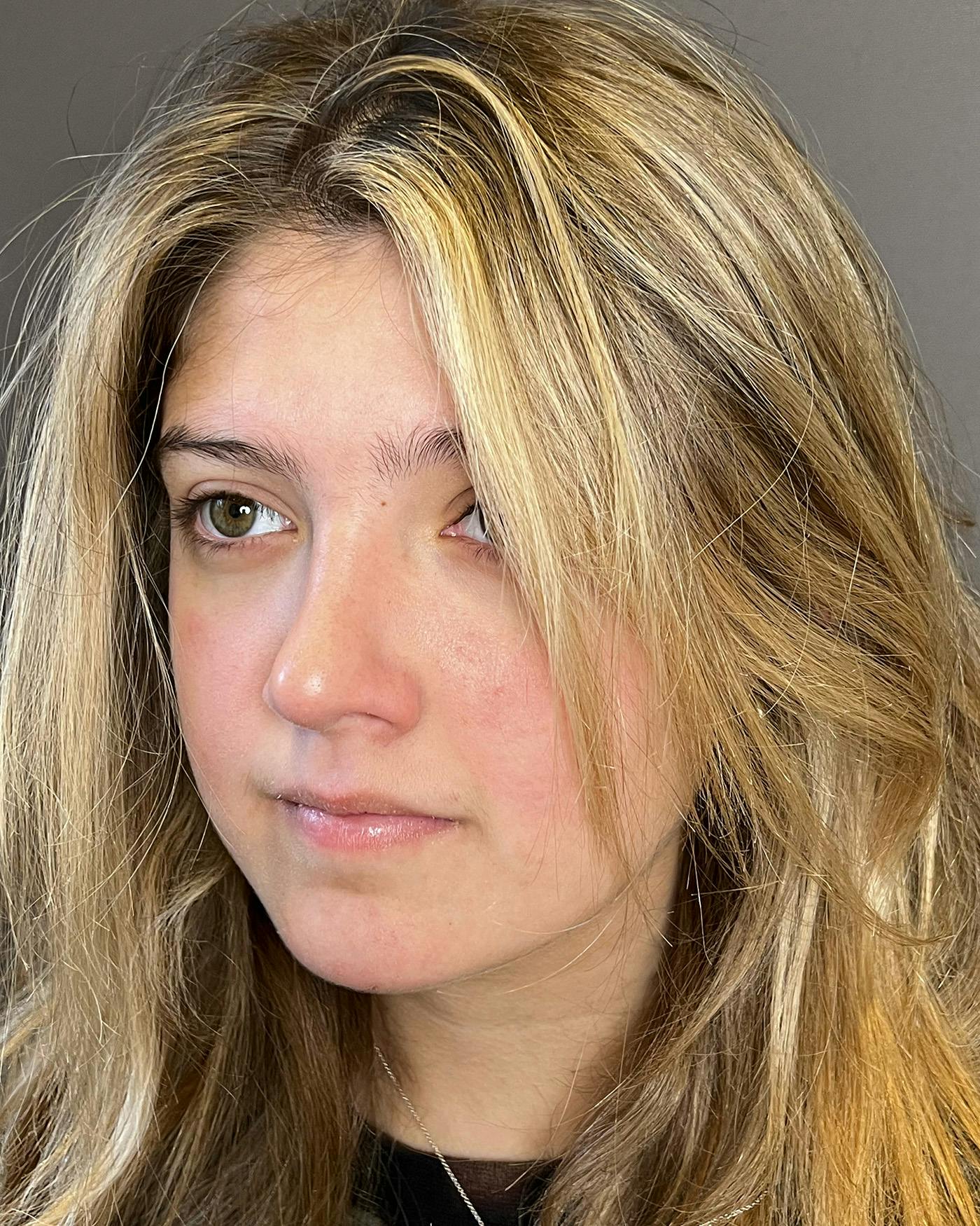 Rhinoplasty Before & After Gallery - Patient 191298487 - Image 8