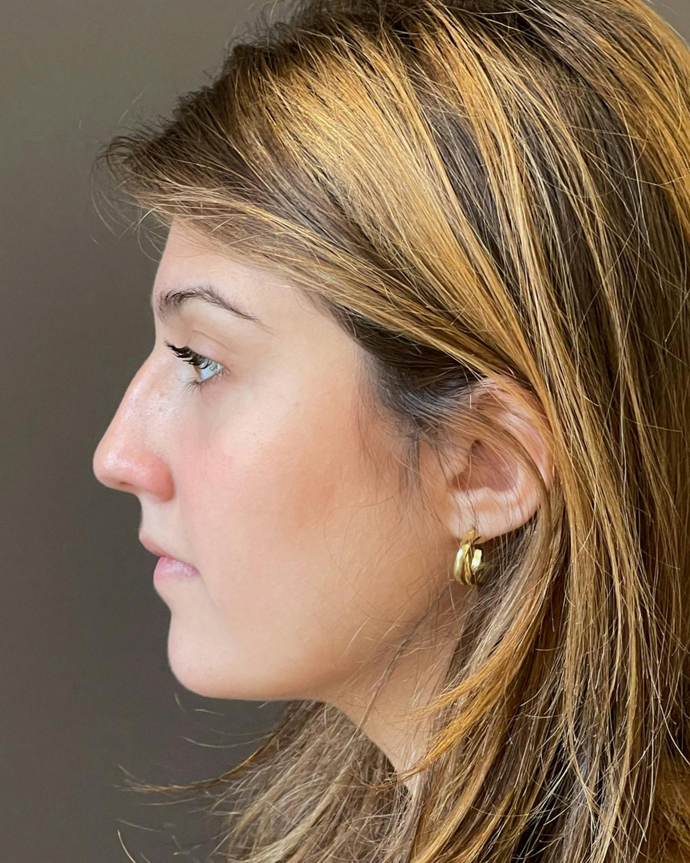 Rhinoplasty Before & After Gallery - Patient 191298487 - Image 9