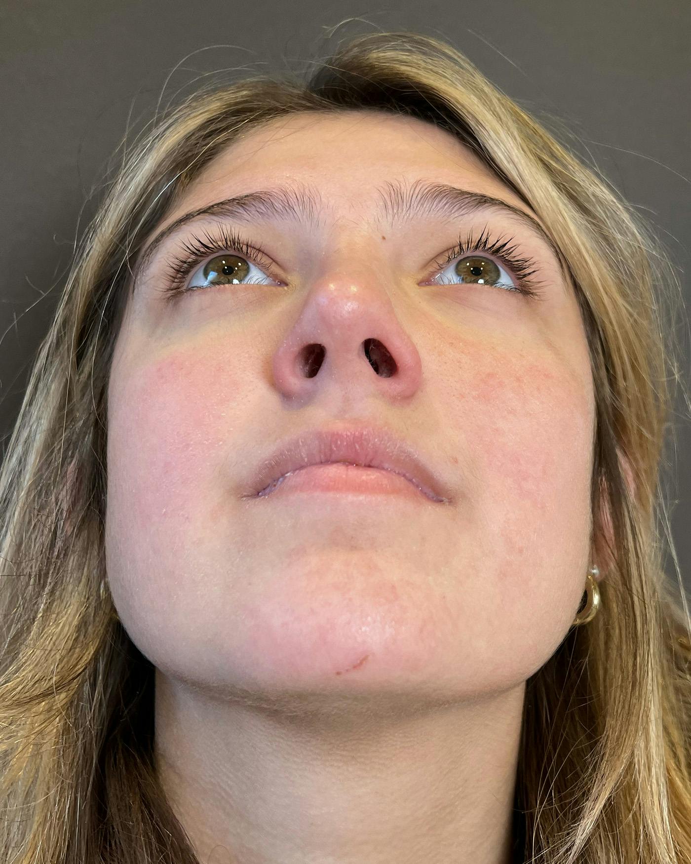 Rhinoplasty Before & After Gallery - Patient 191298487 - Image 12