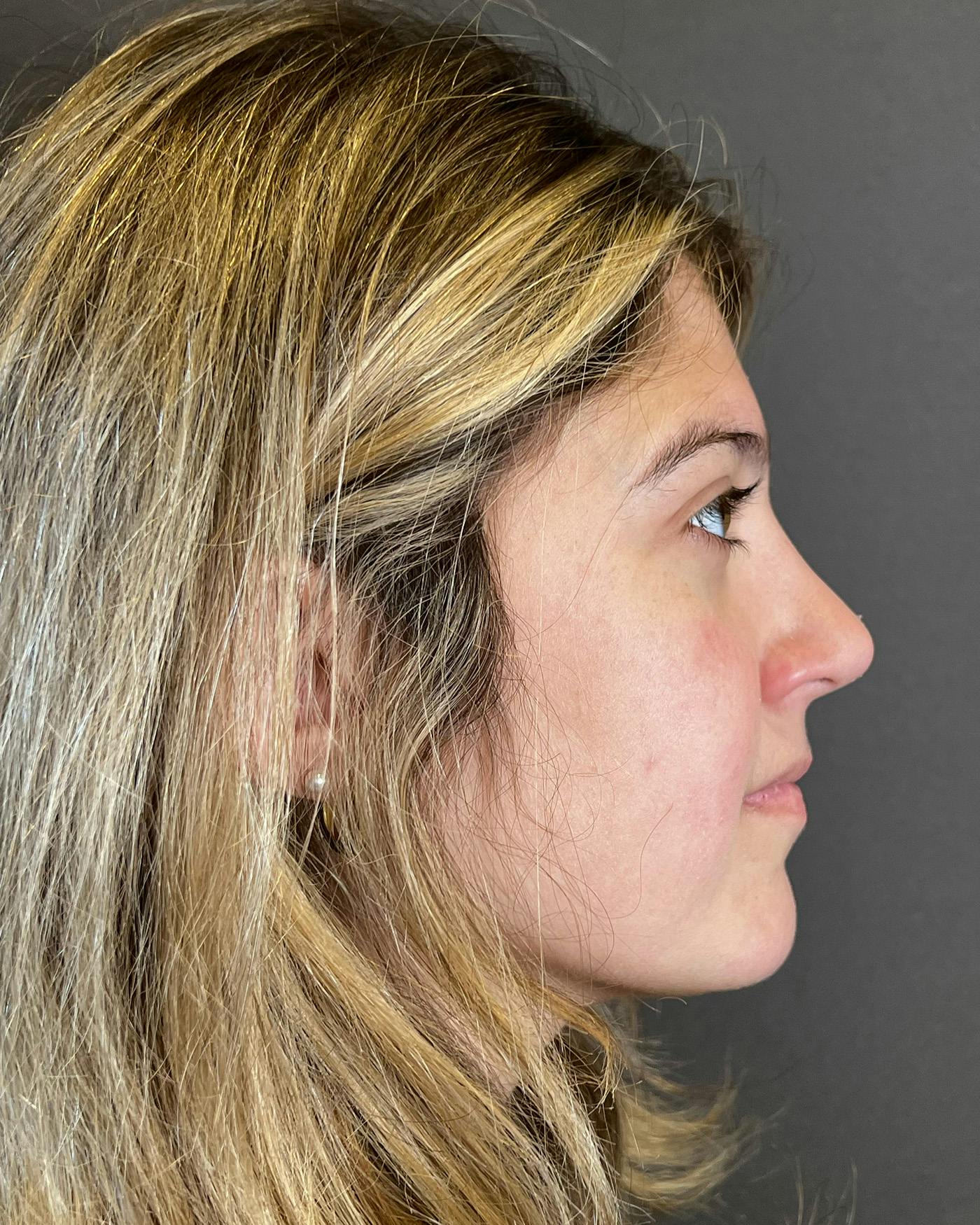 Rhinoplasty Before & After Gallery - Patient 191298487 - Image 2