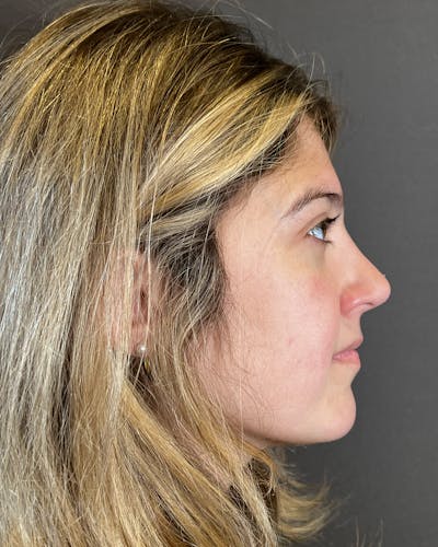 Rhinoplasty Before & After Gallery - Patient 191298487 - Image 2