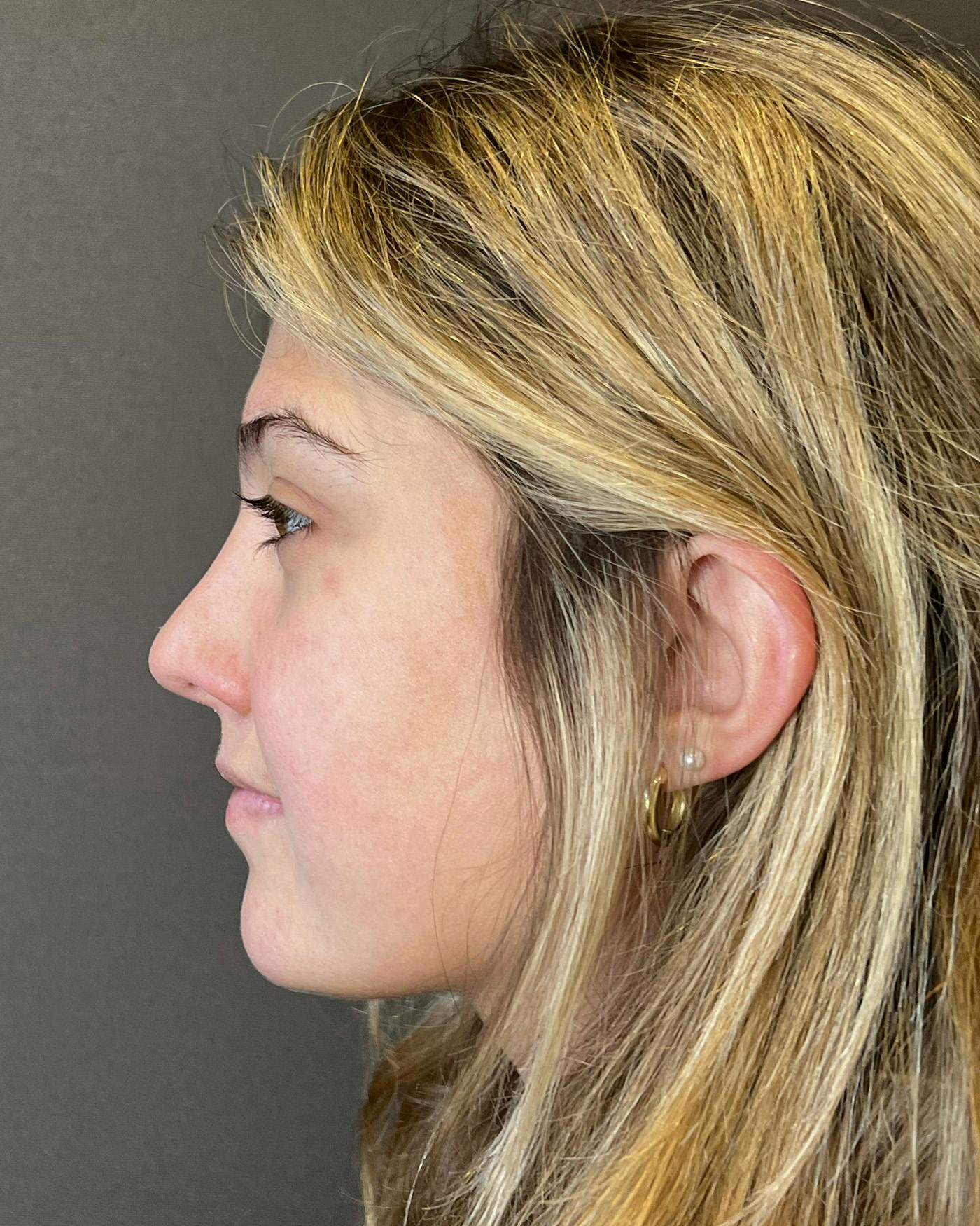 Rhinoplasty Before & After Gallery - Patient 191298487 - Image 10