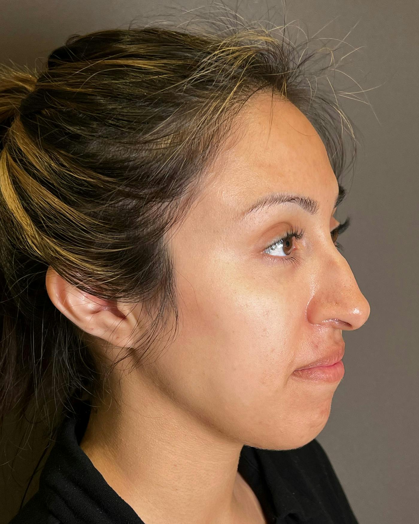 Rhinoplasty before in NYC with Albert Plastic Surgery right profile view p#5