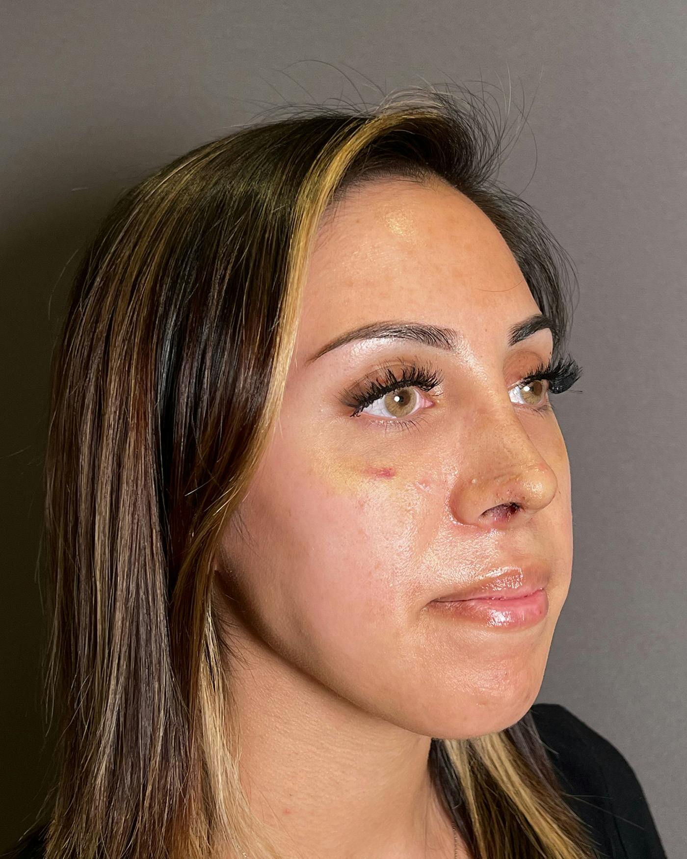 Rhinoplasty after in NYC with Albert Plastic Surgery right profile view p#5