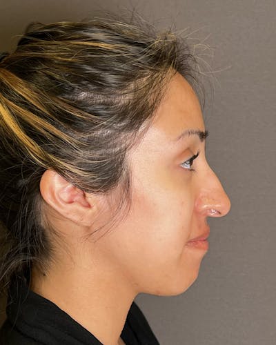 Rhinoplasty before in NYC with Albert Plastic Surgery right side view p#5