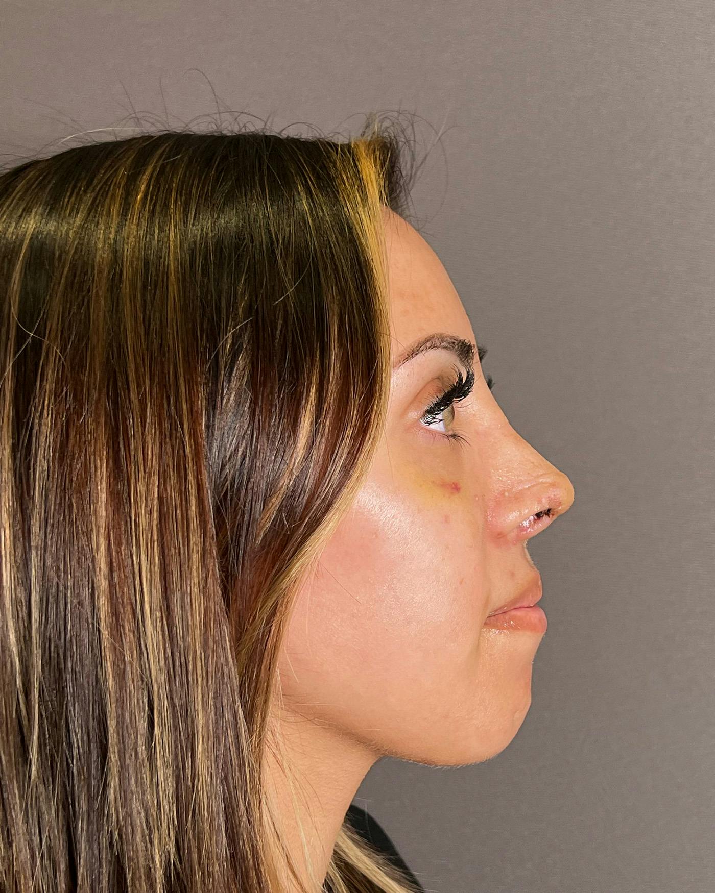 Rhinoplasty after in NYC with Albert Plastic Surgery right side view p#5