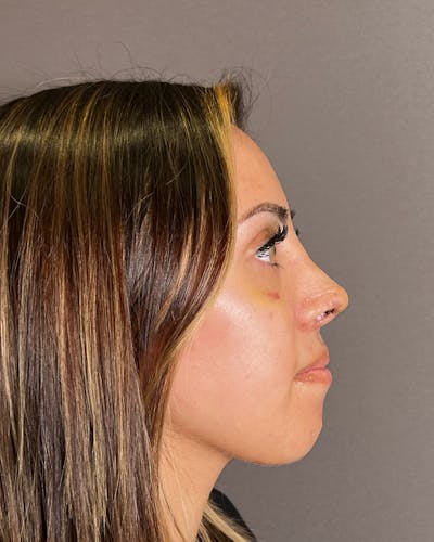 Rhinoplasty after in NYC with Albert Plastic Surgery right side view p#5