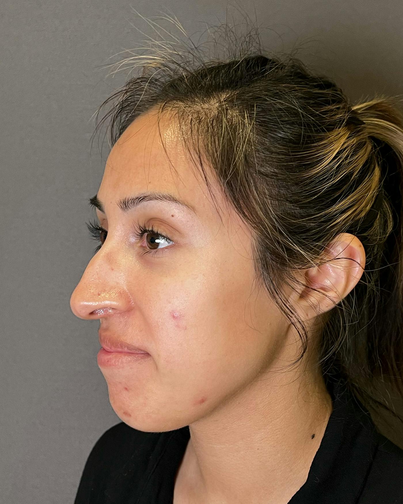 Rhinoplasty before in NYC with Albert Plastic Surgery left profile view p#5