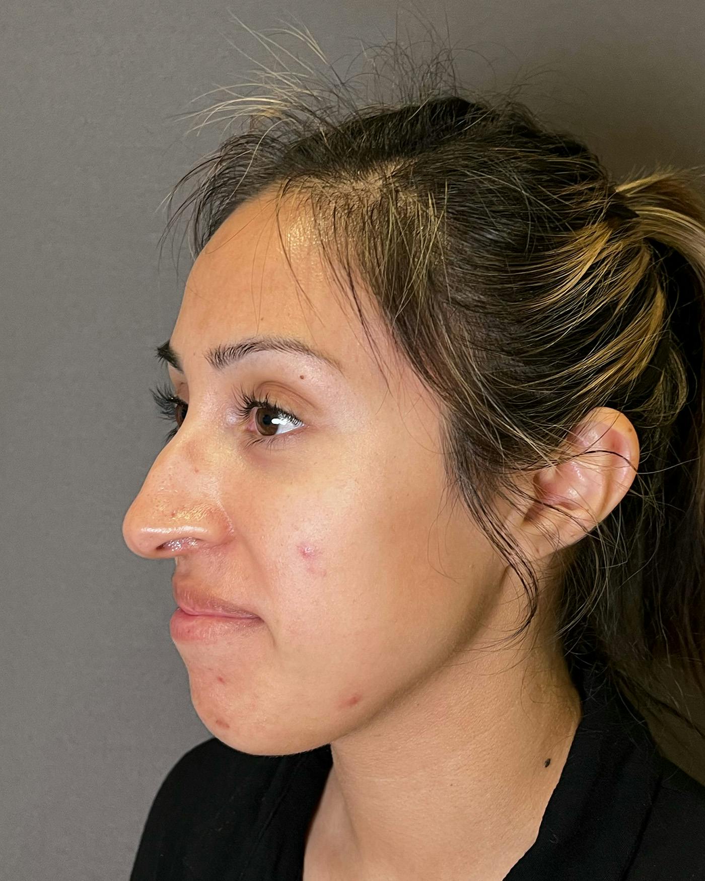 Rhinoplasty Before & After Gallery - Patient 191298499 - Image 5