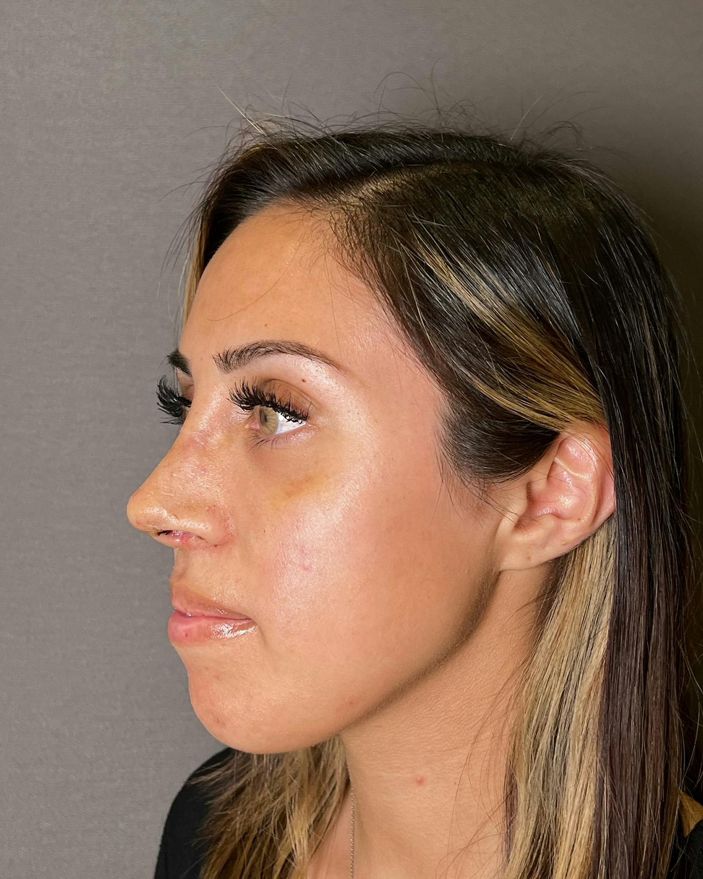 Rhinoplasty before in NYC with Albert Plastic Surgery left profile view p#5