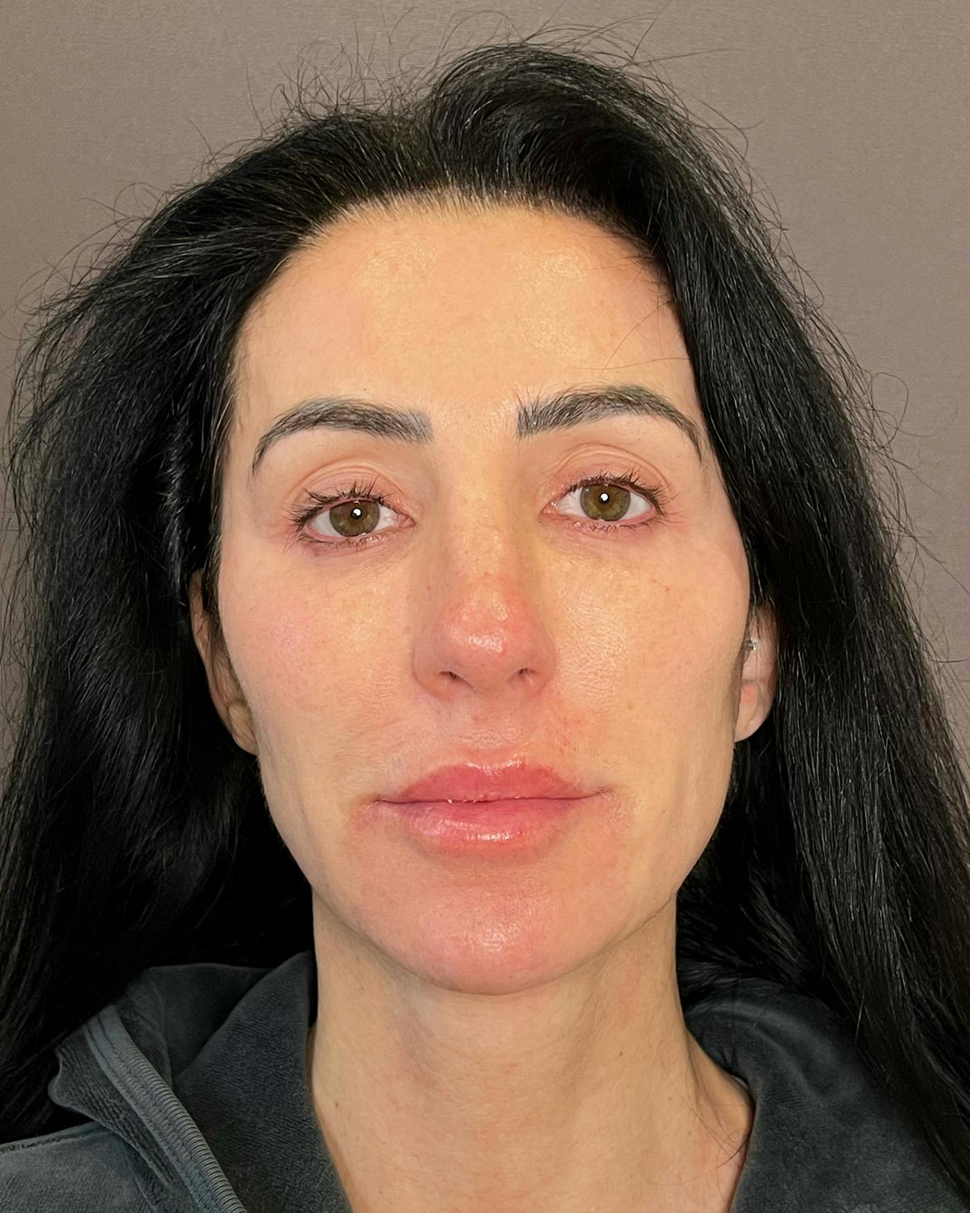 Rhinoplasty before in NYC with Albert Plastic Surgery front view p#4