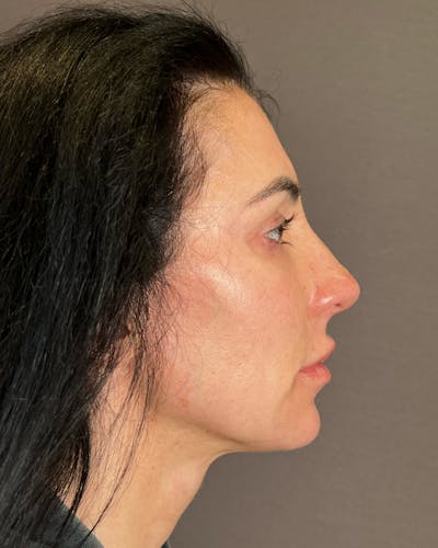 Rhinoplasty before in NYC with Albert Plastic Surgery right side view p#4
