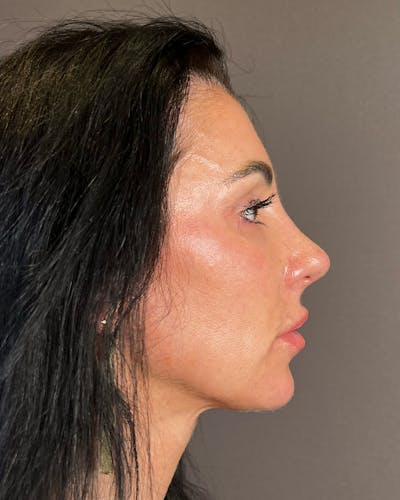 Rhinoplasty after in NYC with Albert Plastic Surgery right side view p#4