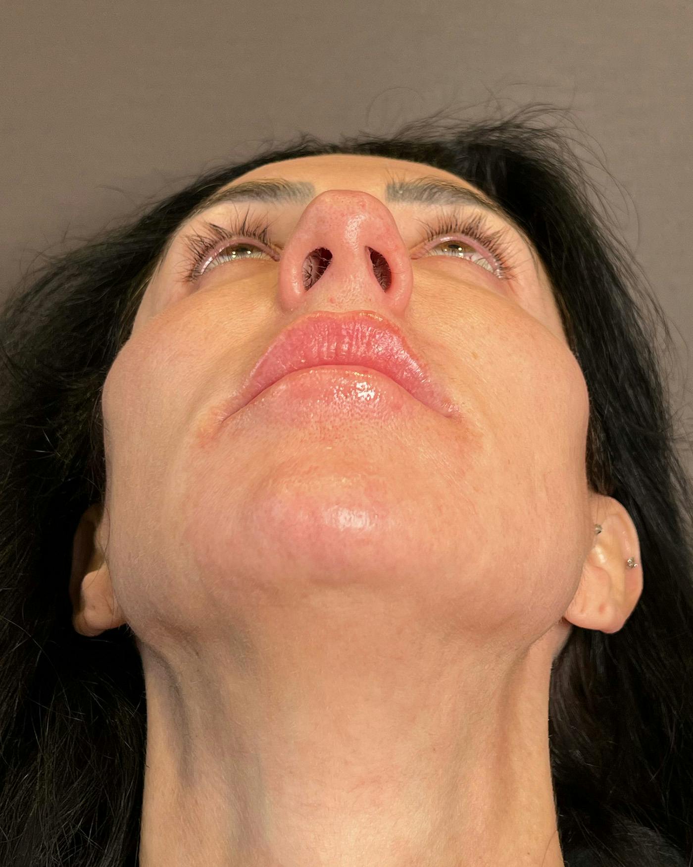 Rhinoplasty before in NYC with Albert Plastic Surgery under view p#4