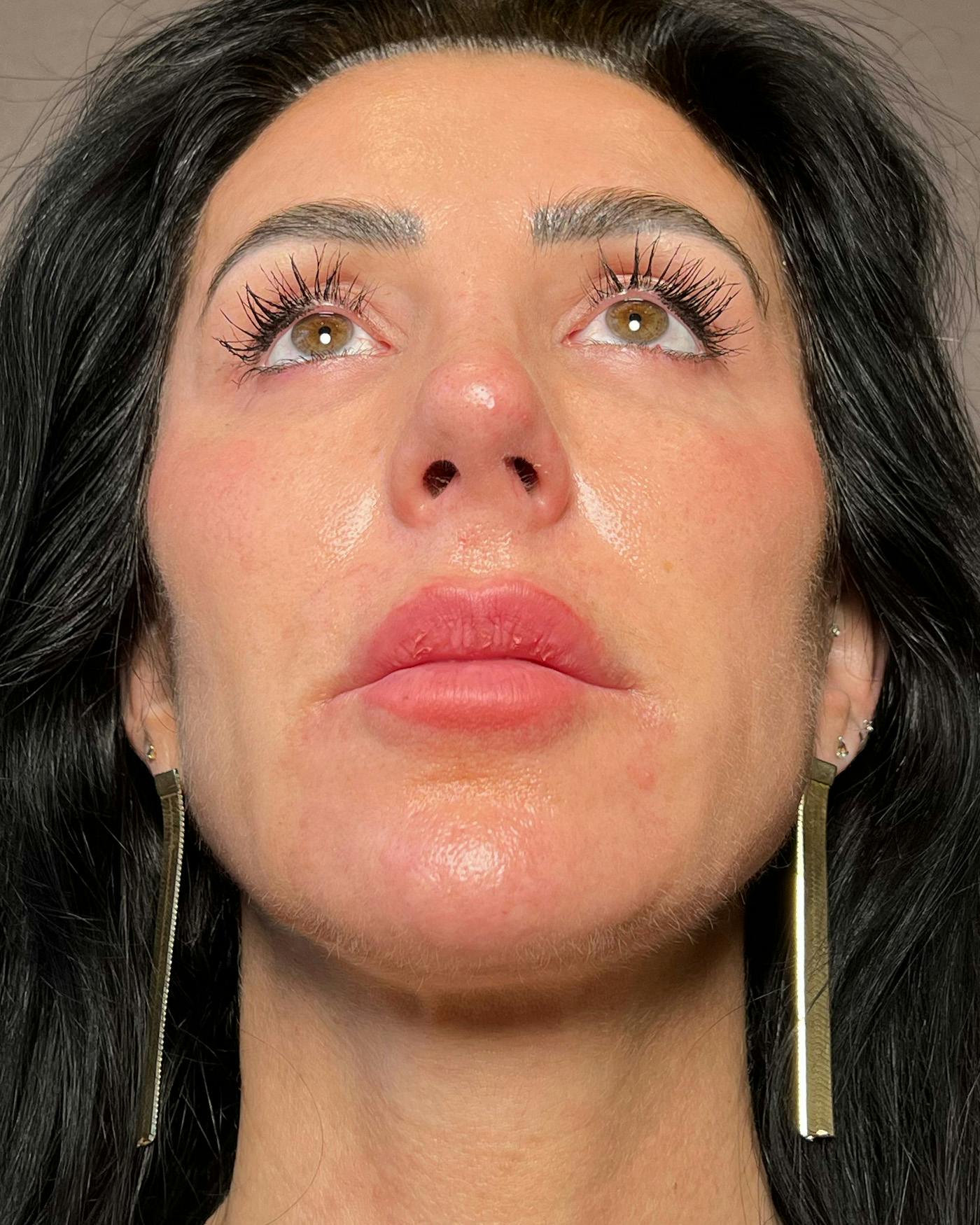 Rhinoplasty after in NYC with Albert Plastic Surgery under view p#4