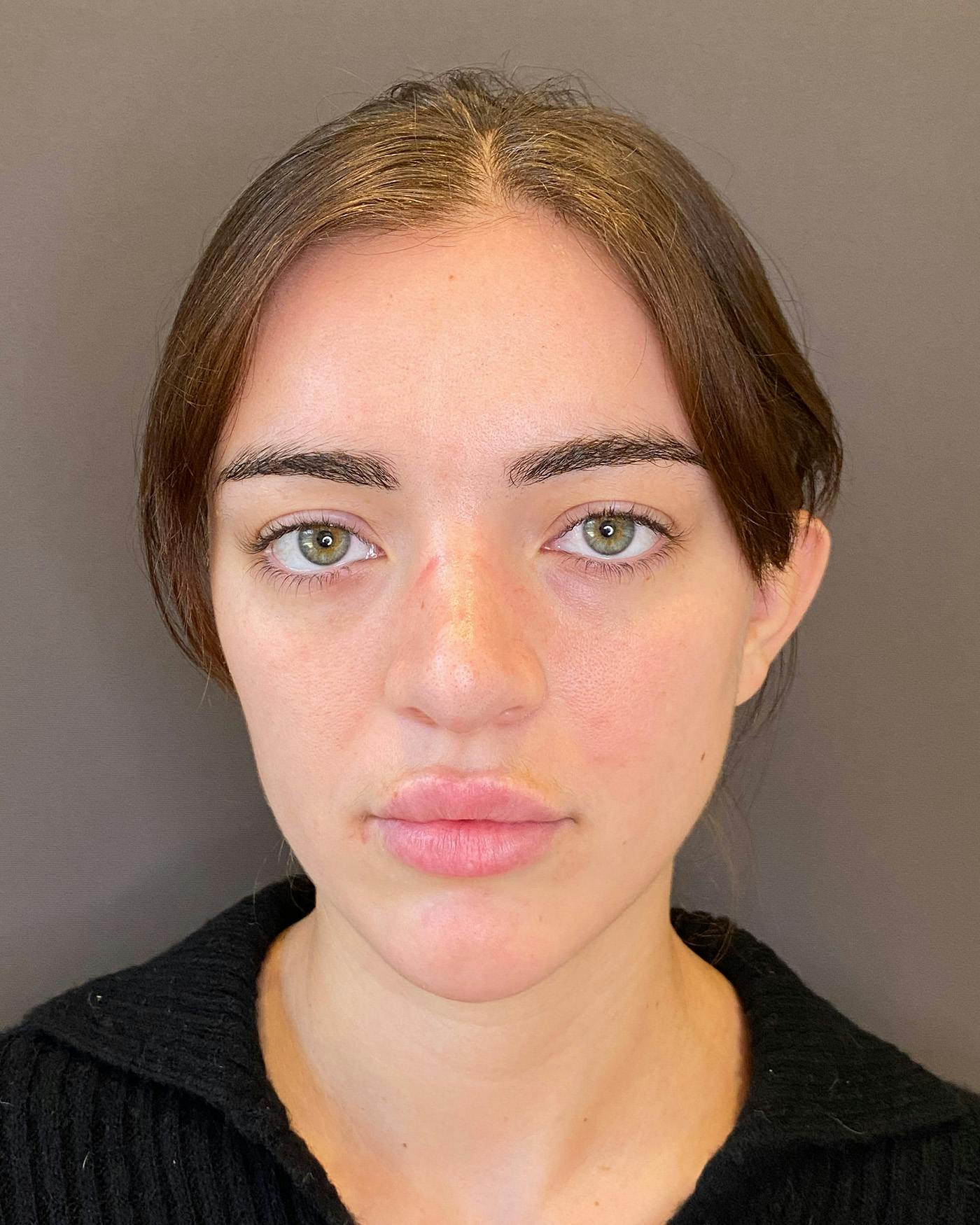 Rhinoplasty before in NYC with Albert Plastic Surgery front view p#3