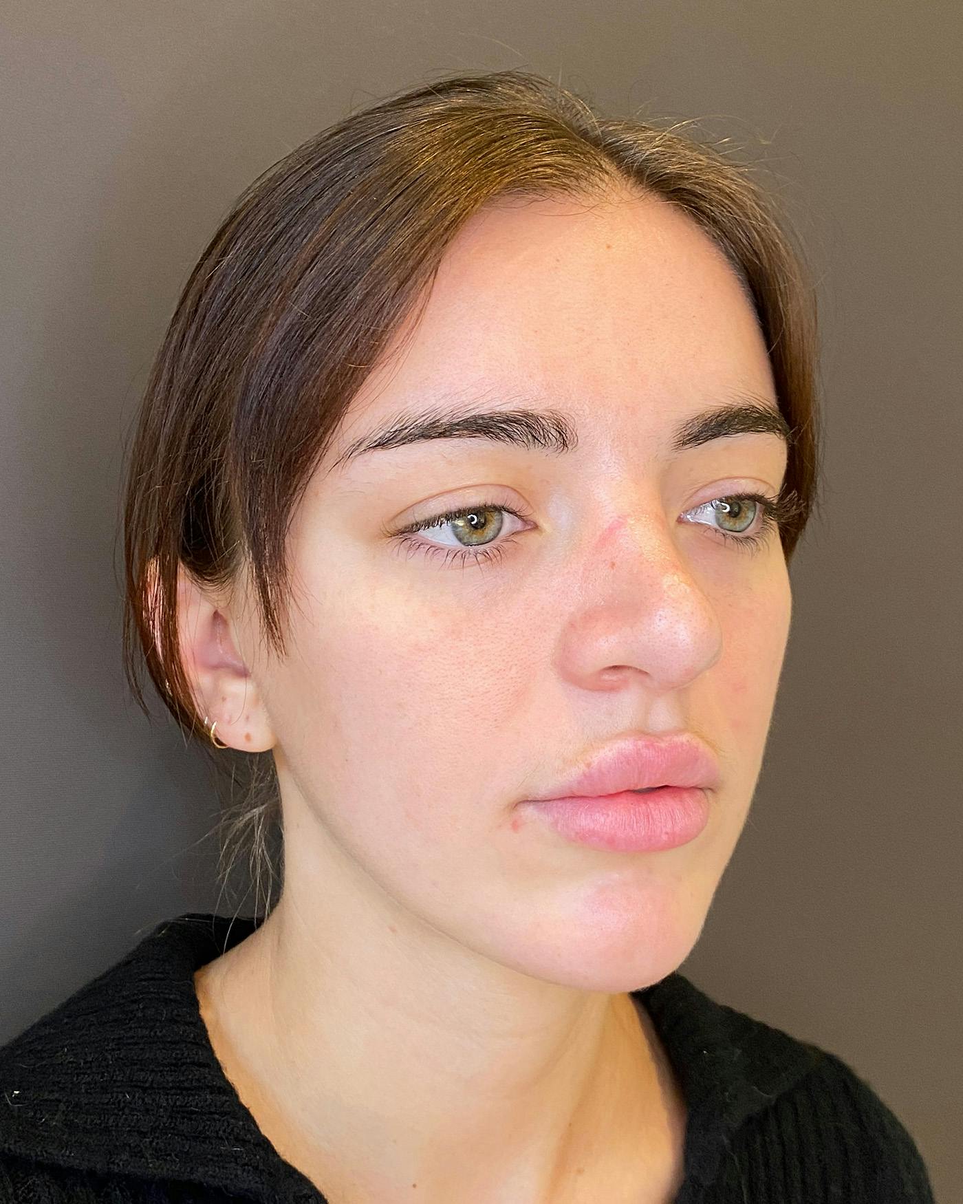 Rhinoplasty before in NYC with Albert Plastic Surgery right profile view p#3