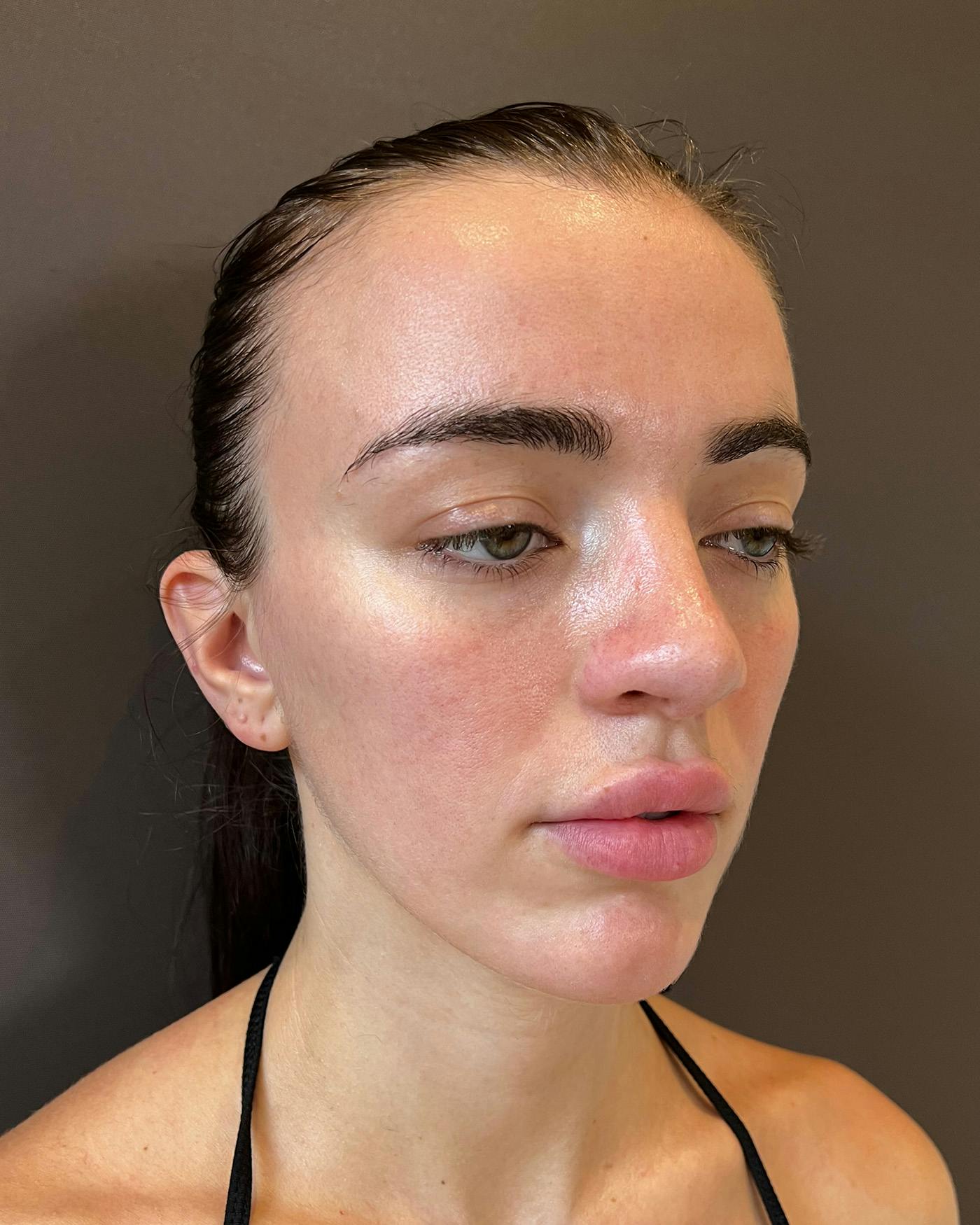 Rhinoplasty after in NYC with Albert Plastic Surgery right profile view p#3