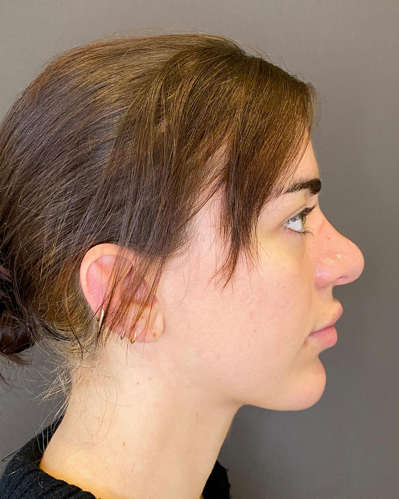 Rhinoplasty before in NYC with Albert Plastic Surgery right side view p#3
