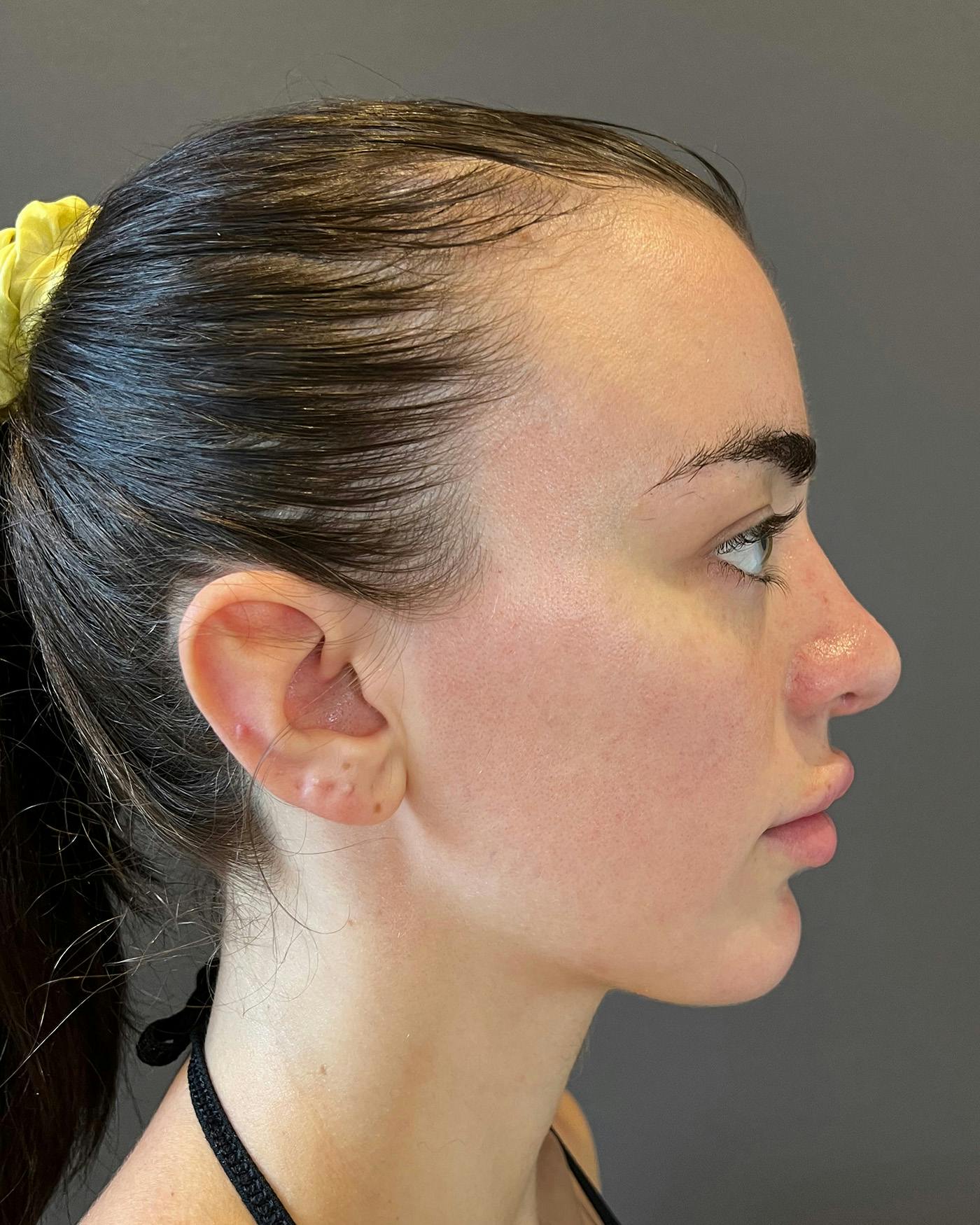 Rhinoplasty after in NYC with Albert Plastic Surgery right side view p#3