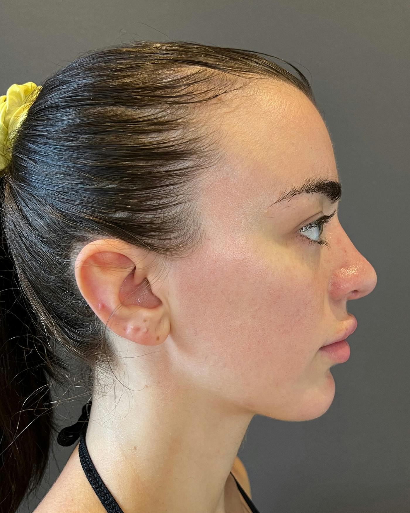 Rhinoplasty Before & After Gallery - Patient 191298628 - Image 2